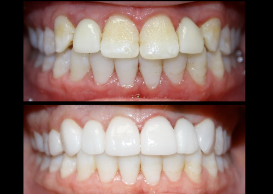 ceramic crowns and veneers are available at norman smile center