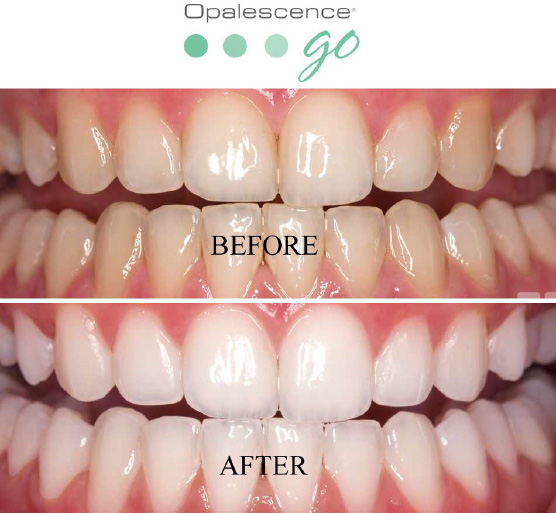 Opalesence is available at norman smile center